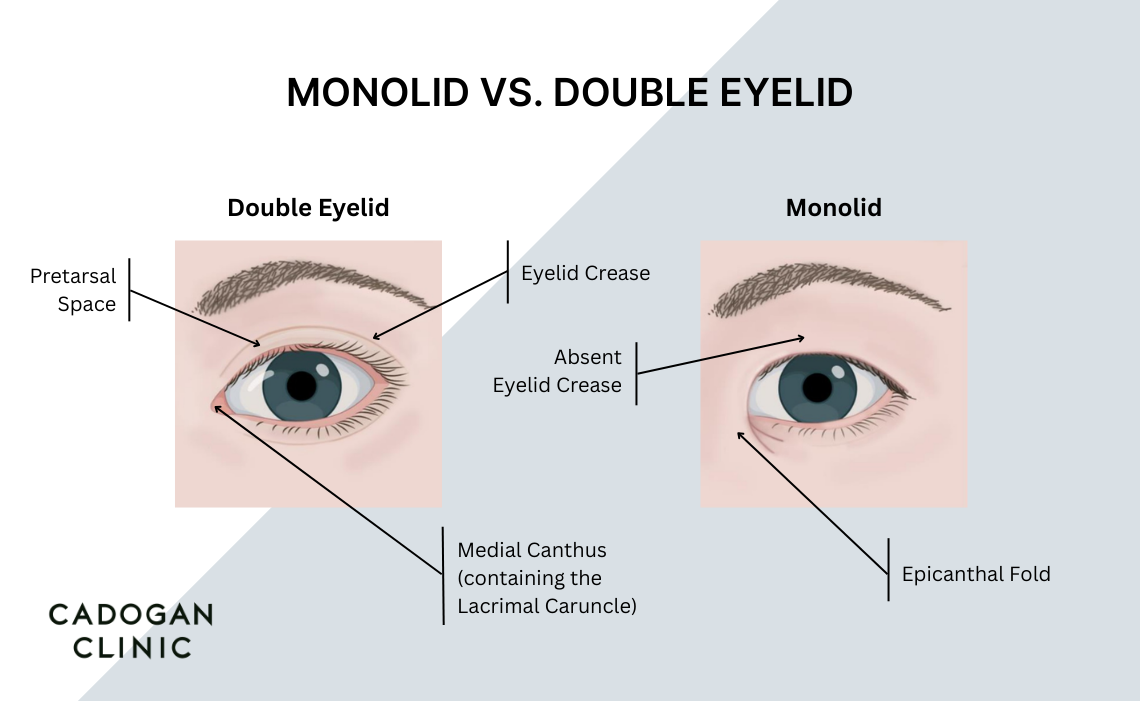 Infographic showing the physical differences betwee a monolid and a double eyelid